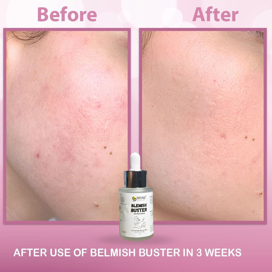 Blemish Buster-Anti Acne
